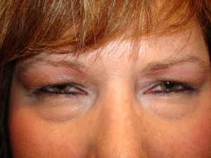 Upper-and-Lower-Lid-Blephpreop